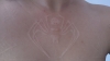 scarification