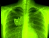 sözlük kızlarının akciğer röntgenleri