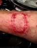 scarification