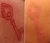 scarification