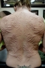 scarification