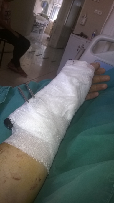 skafoid el bileği kırığı